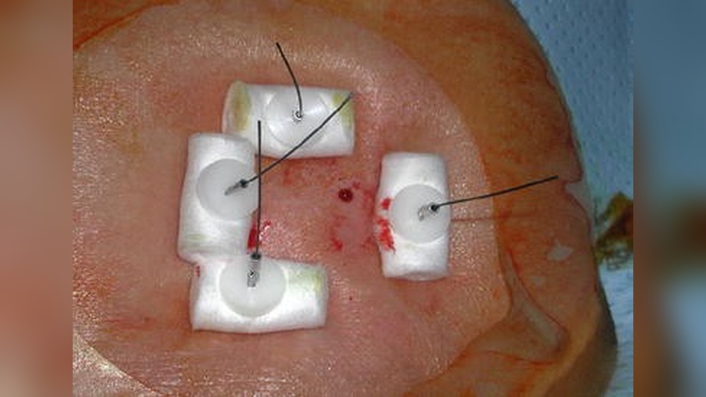 How to Remove G Tube T-Fasteners